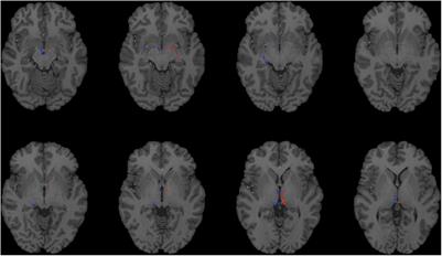 Laterality and Sex Differences of Human Lateral Habenula Afferent and Efferent Fiber Tracts